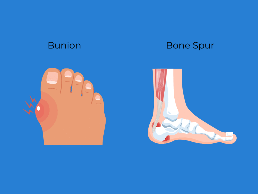 Bunion vs Bone Spur: How to Tell the Difference and What to Do About It