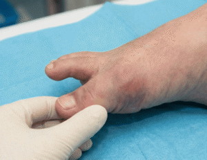 A podiatrist examining the dislocated big toe of a patient