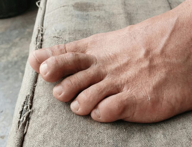 Fix Overlapping Toes: Conservative & Surgical Treatment Solutions