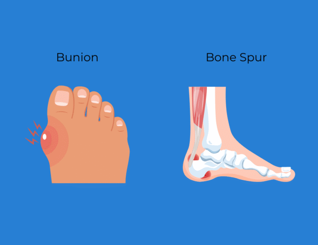 an image showcasing bunion and bone spur effected area in the human body