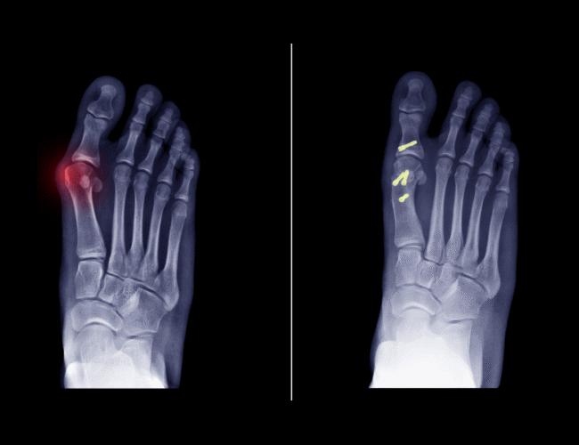 An x-ray image showing before and after of MIS bunion surgery