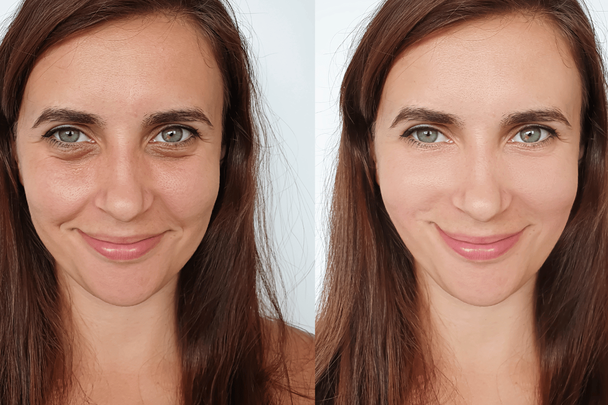 Before and after with dermal fillers